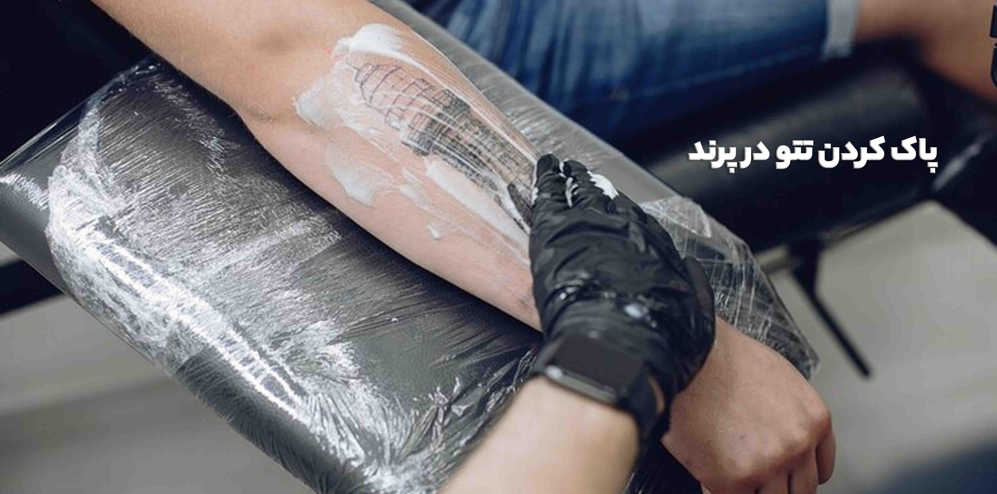 پاک کردن تتو در پرند