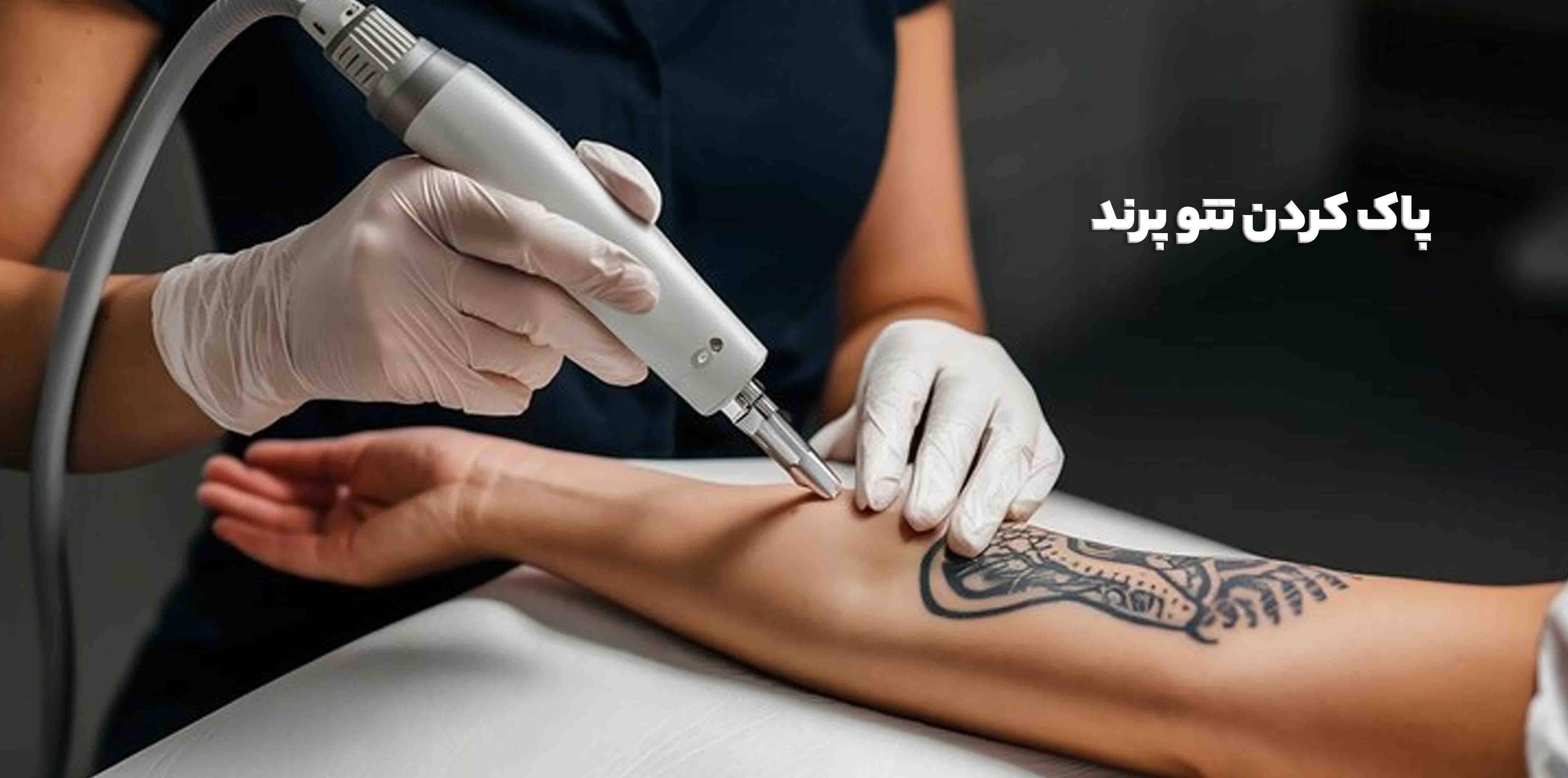 پاک کردن تتو پرند