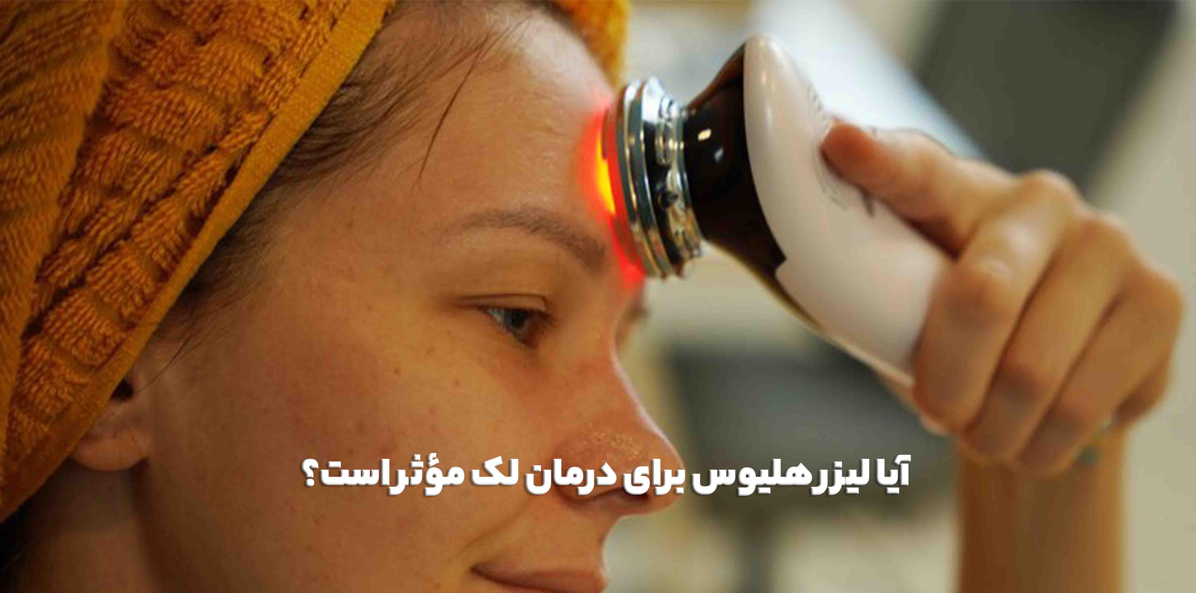 آیا لیزر هلیوس برای درمان لک مؤثر است؟