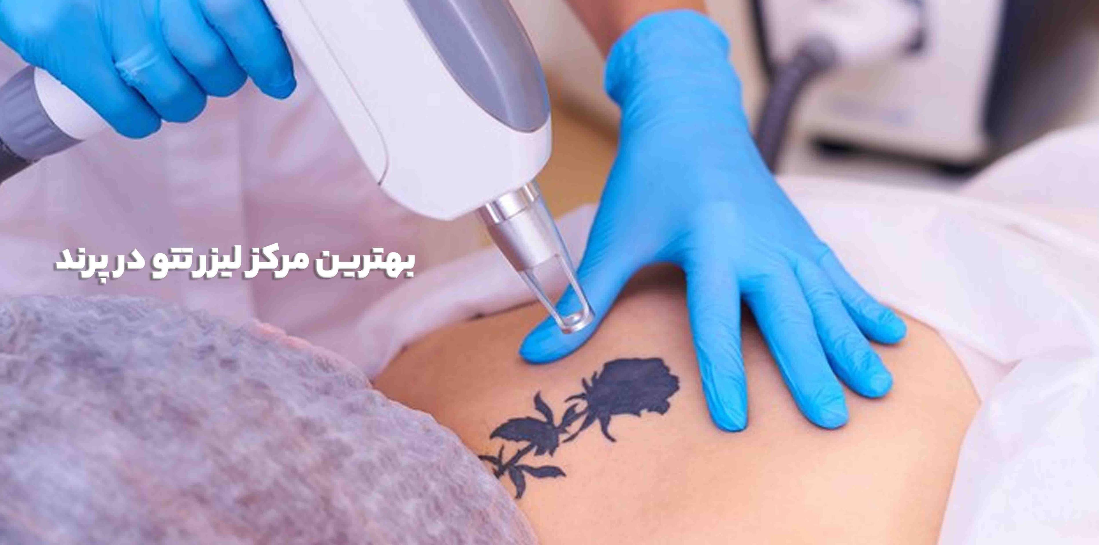 بهترین مرکز لیزر تتو در پرند