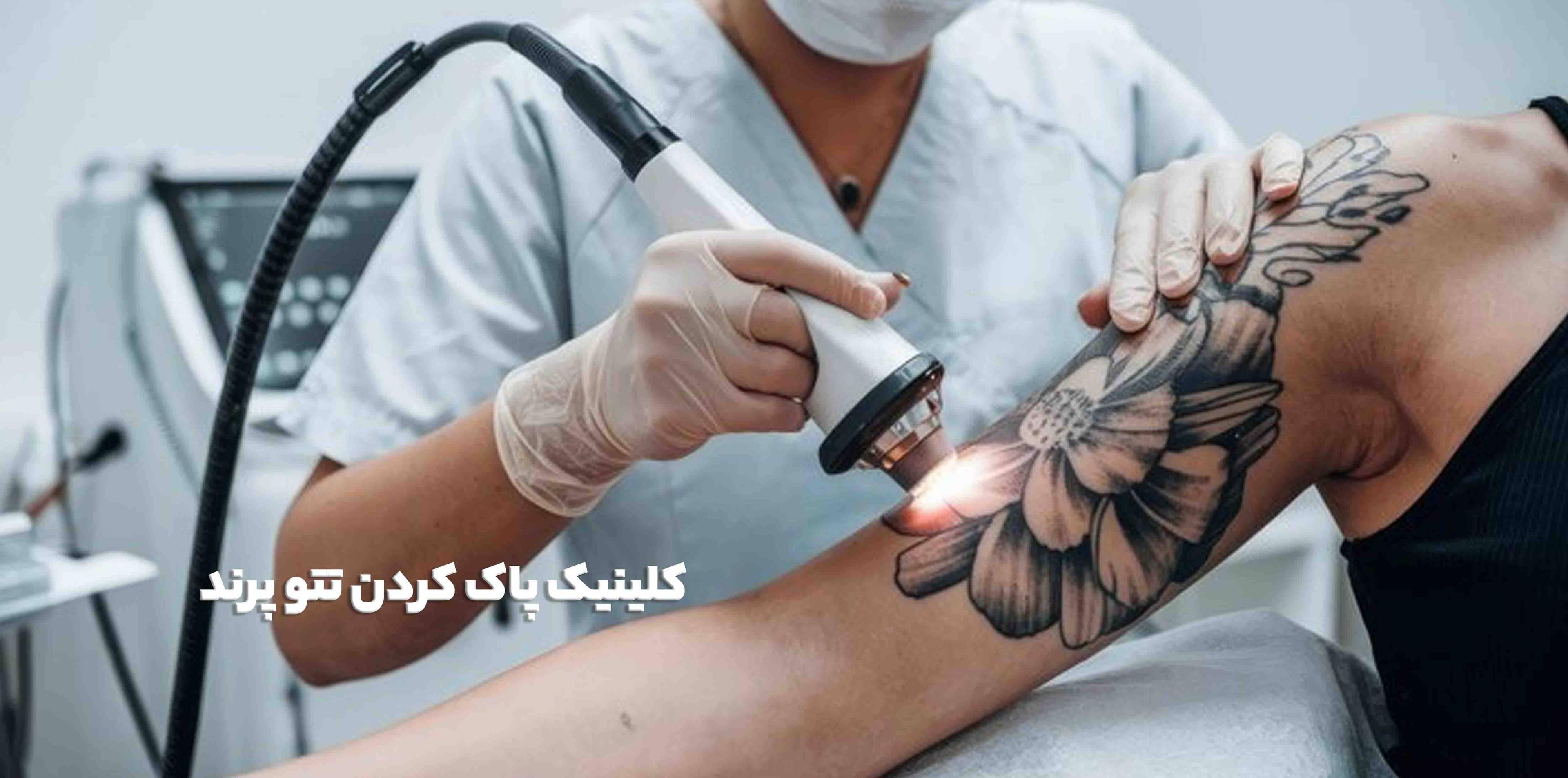 کلینیک پاک کردن تتو پرند