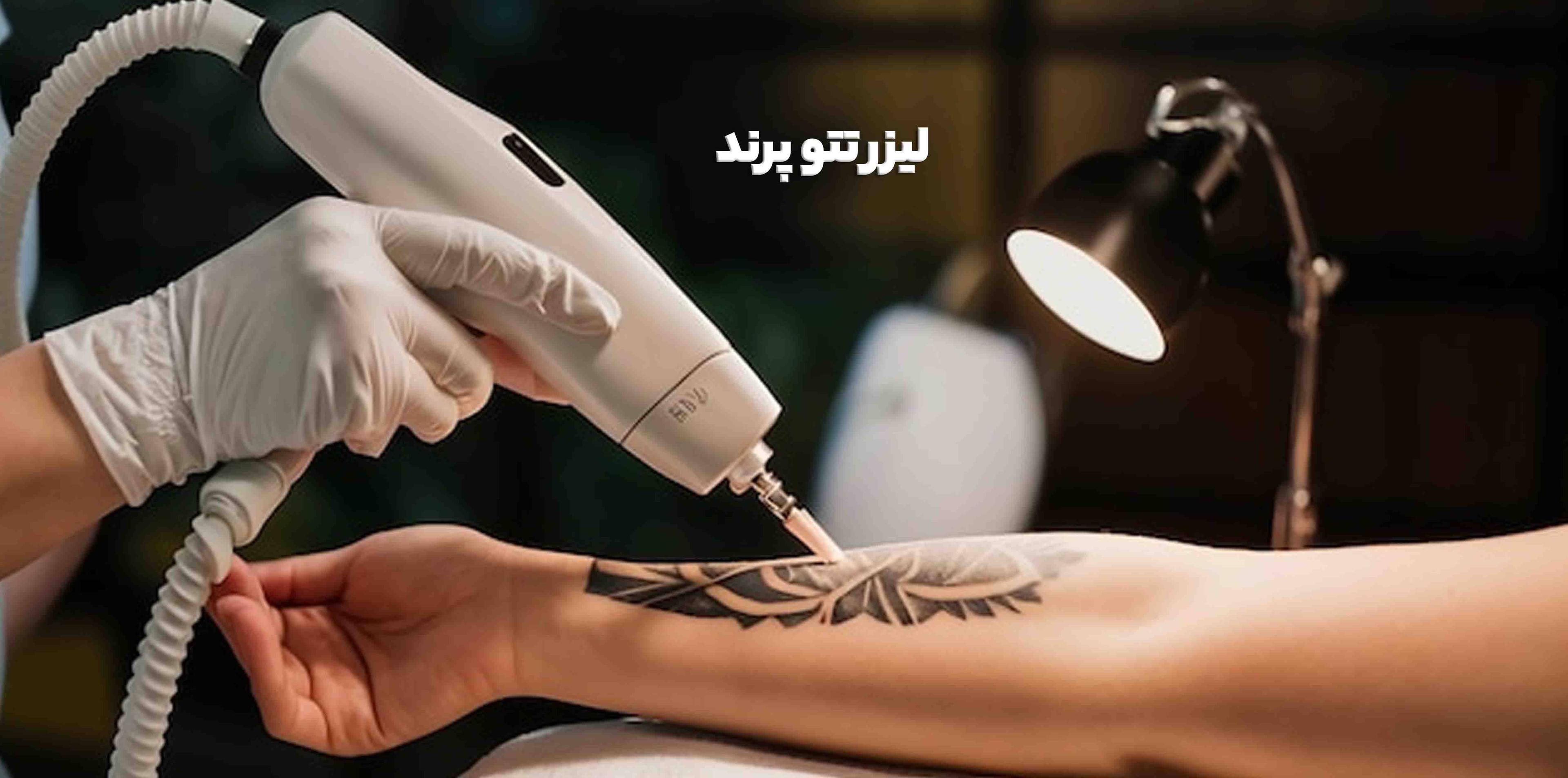 لیزر تتو پرند