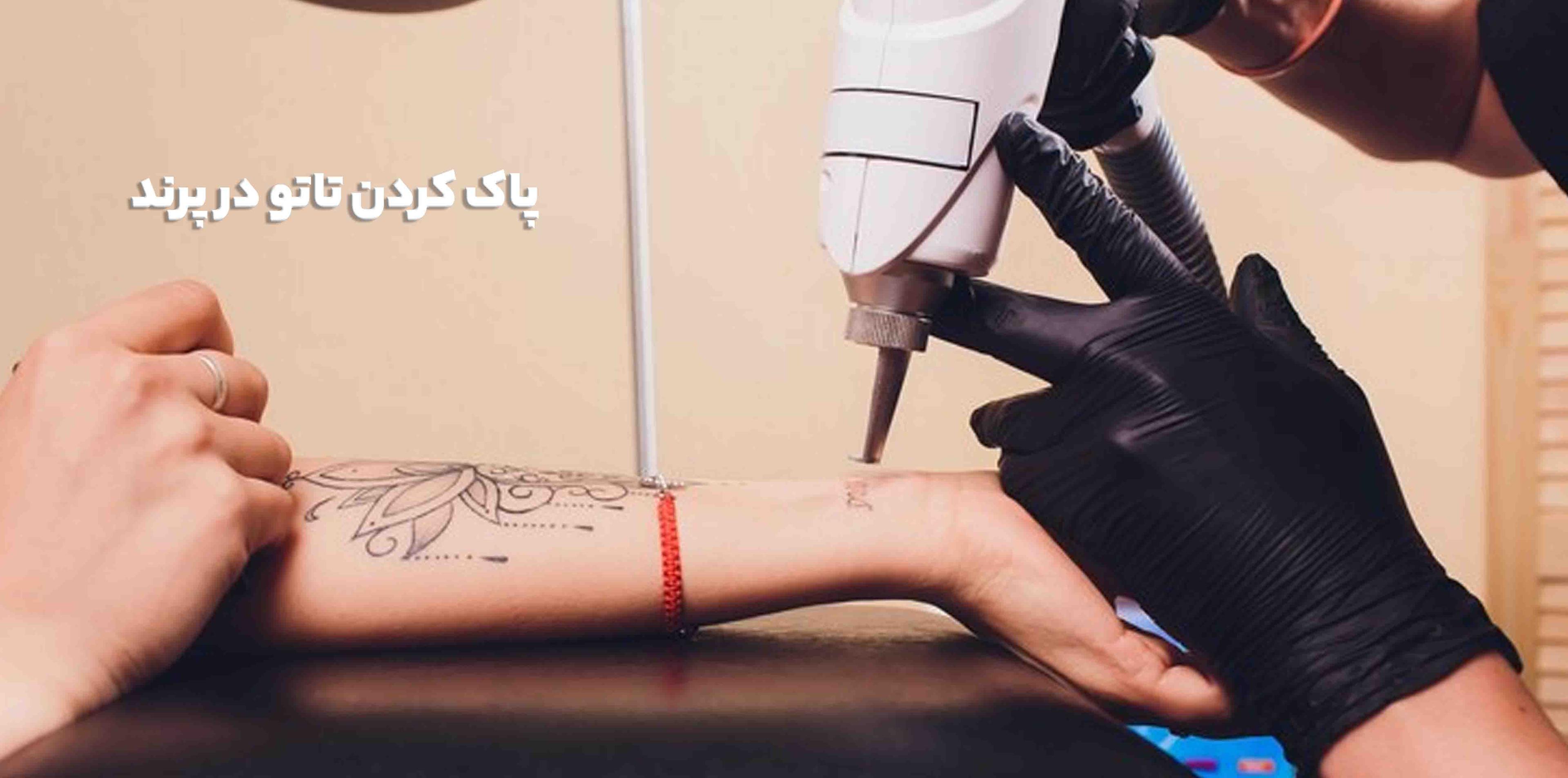 پاک کردن تاتو در پرند