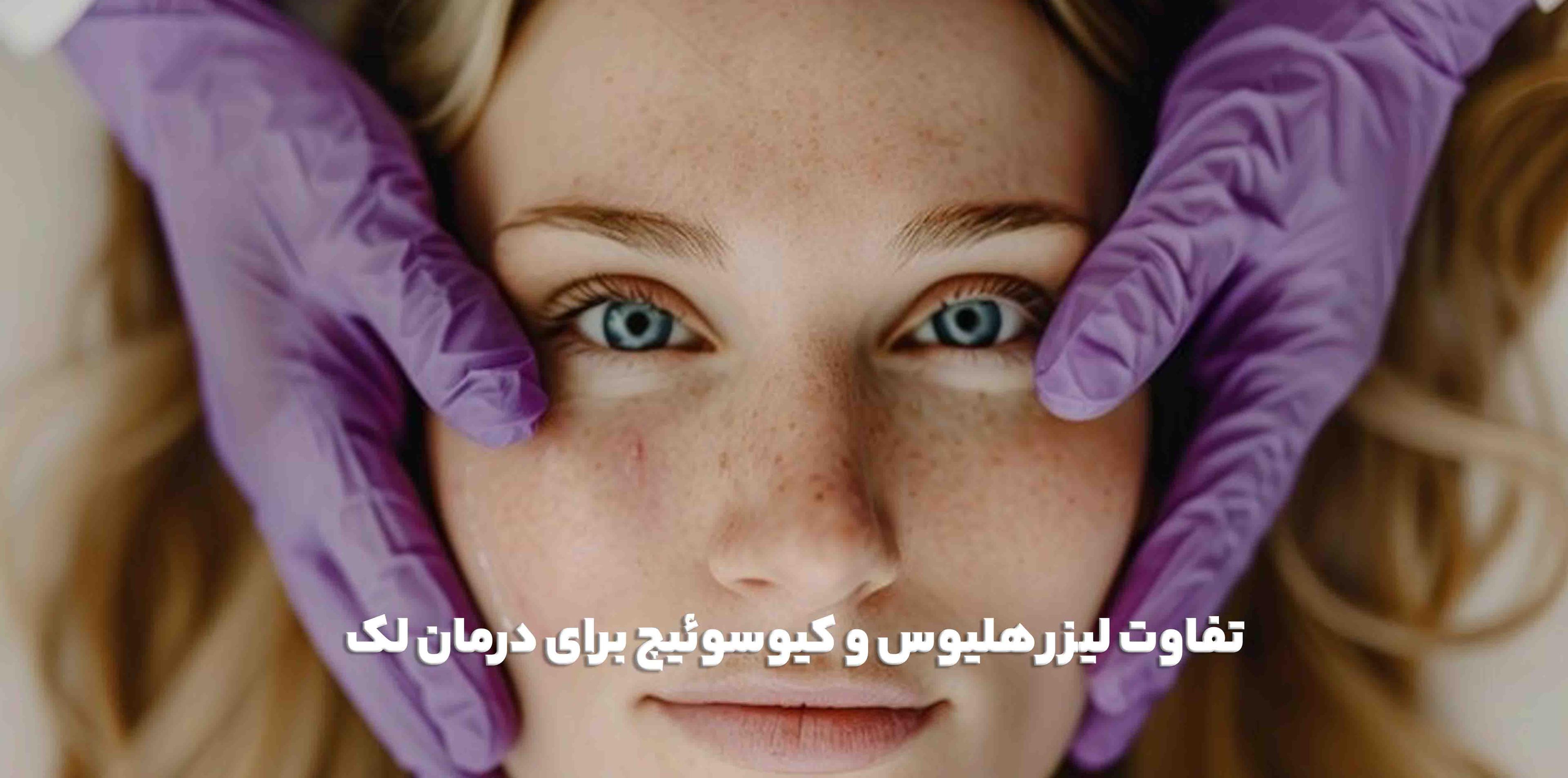 تفاوت لیزر هلیوس و کیوسوئیچ برای درمان لک